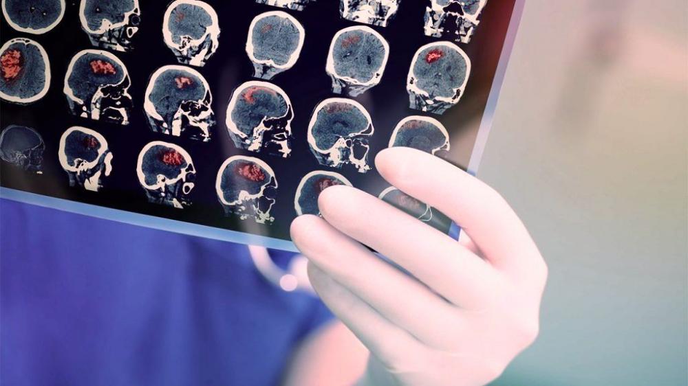 Doenças cerebrais também podem atingir jovens entre idades de 18 à 29 anos