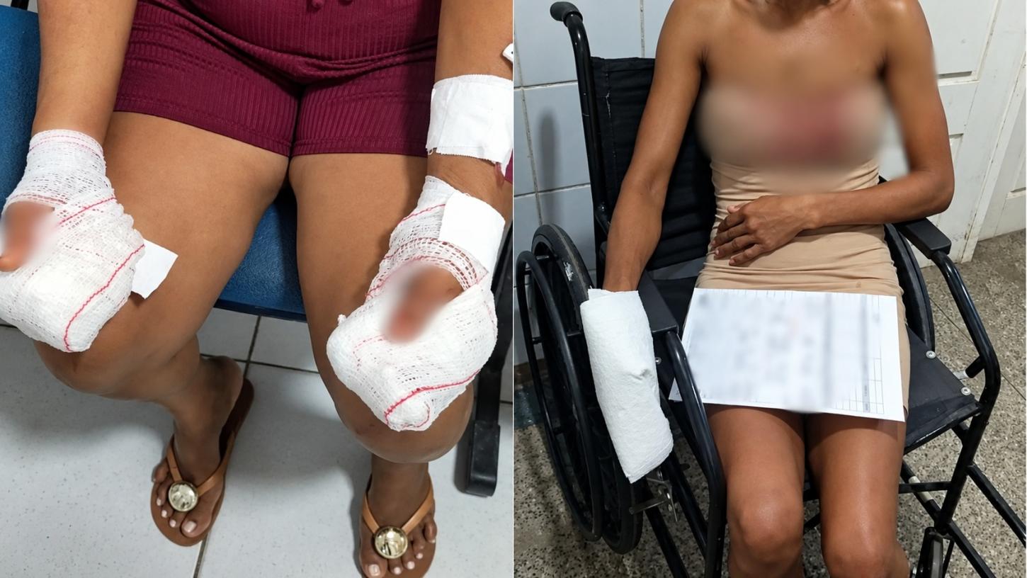 Homem é preso após atacar namorada com faca e decepar dedos da mão da própria mãe com facão em Codó