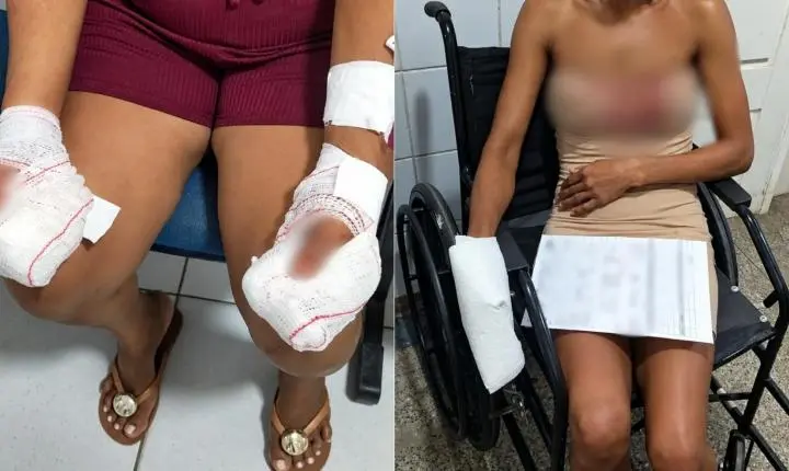 Homem é preso após atacar namorada com faca e decepar dedos da mão da própria mãe com facão em Codó